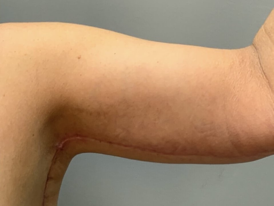 Full Armlift (Front View) After