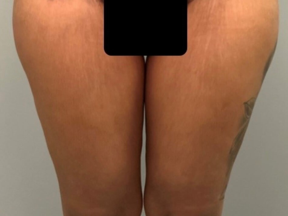 Thighplasty -Front View After