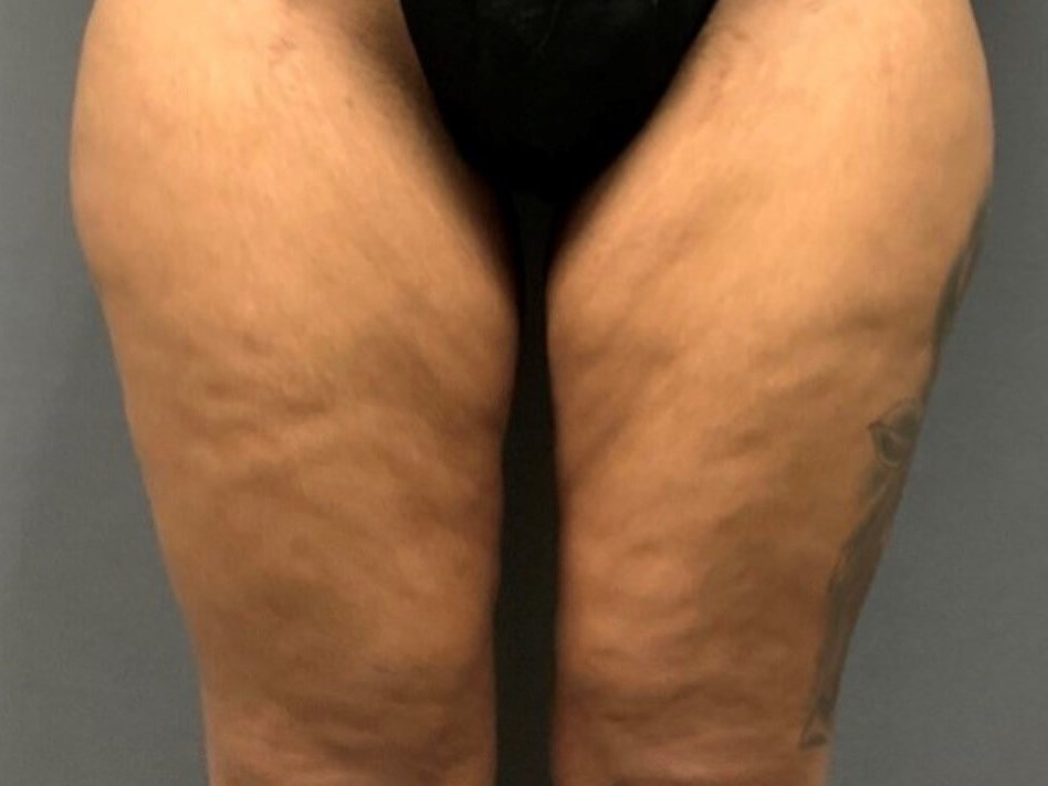 Thighplasty -Front View Before