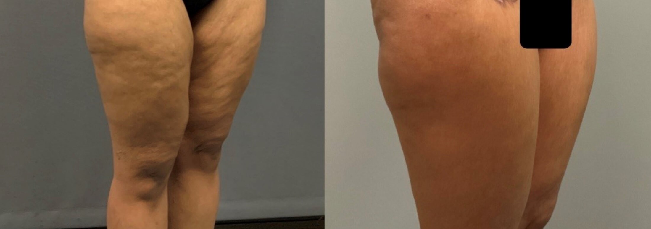 Thighplasty - Side View Before