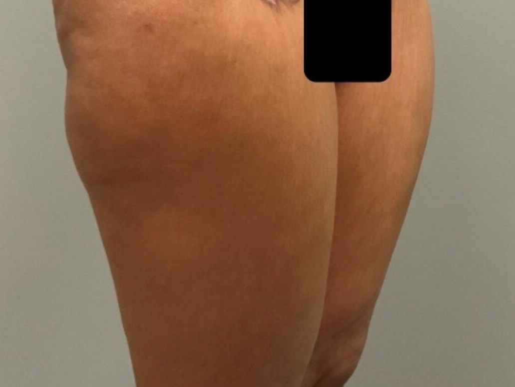 Thighplasty - Side View After