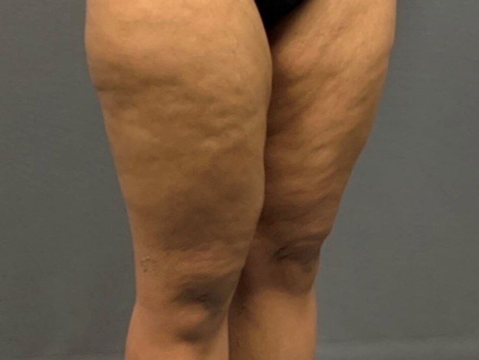 Thighplasty - Side View Before