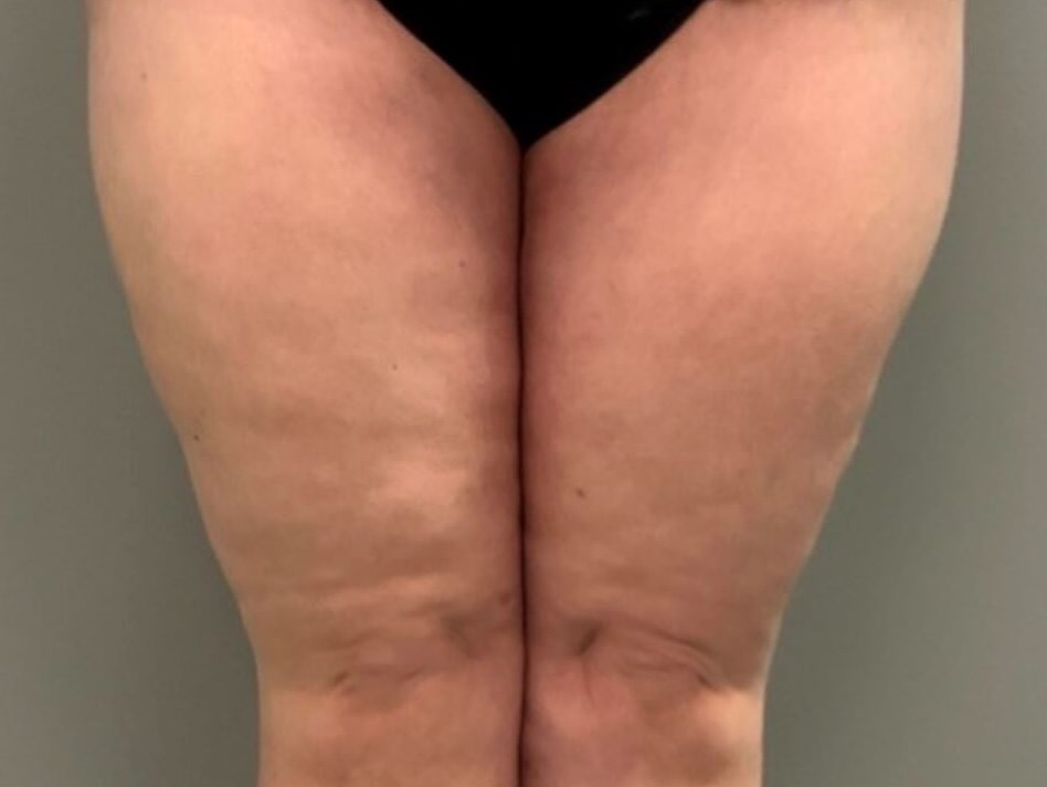 Thighplasty -Front View After
