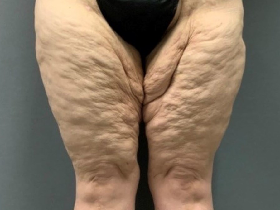 Thighplasty -Front View Before