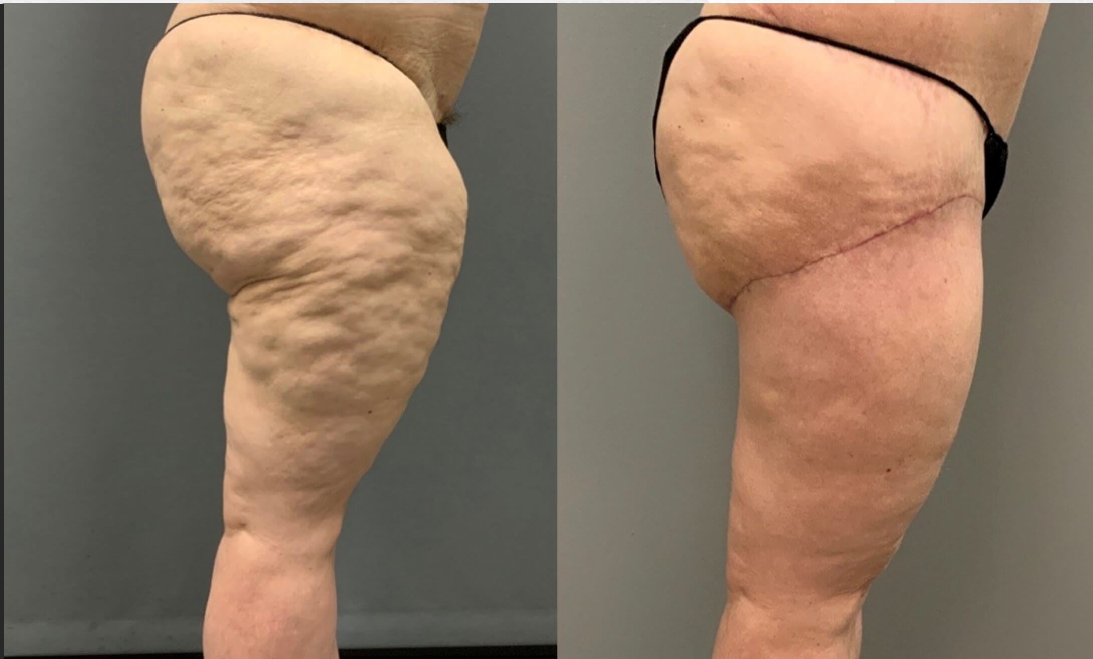 Thighplasty -Side View Before