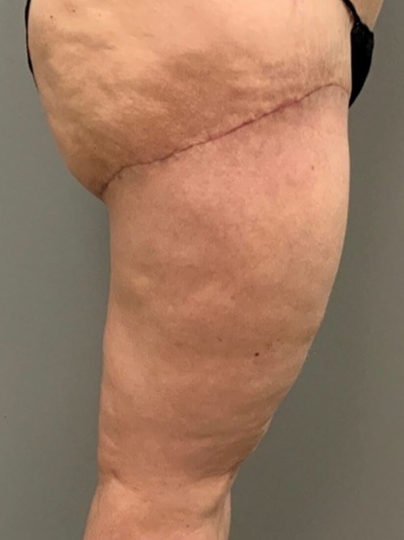 Thighplasty -Side View After
