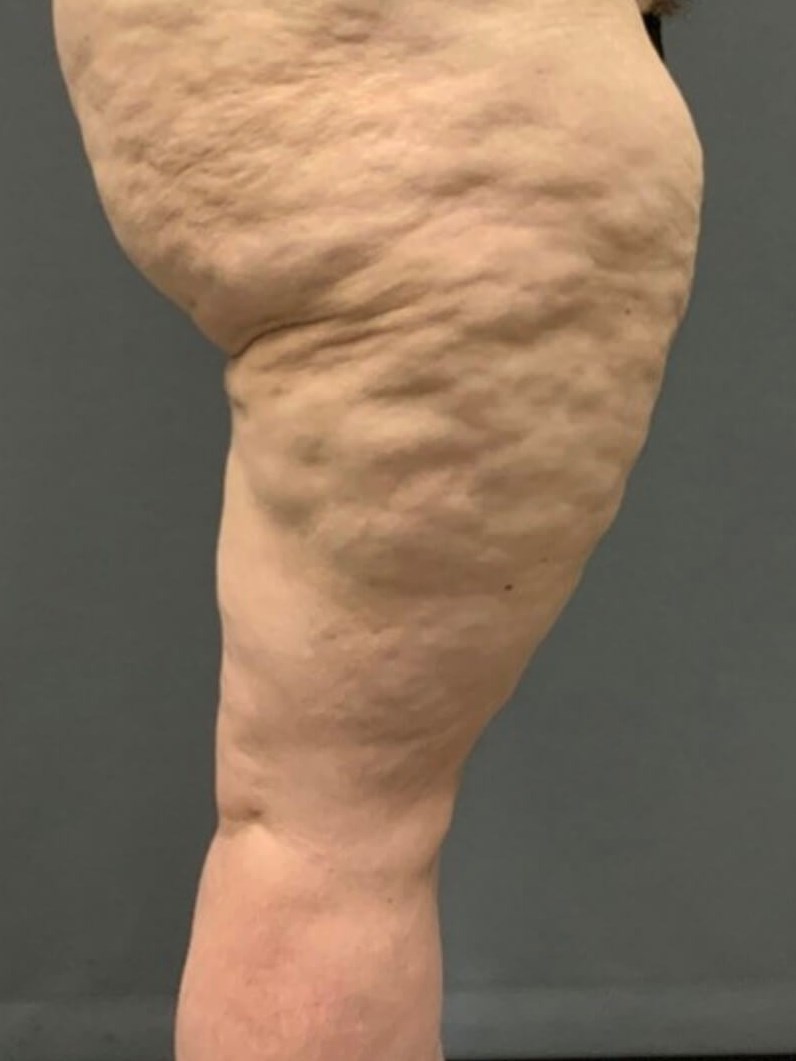 Thighplasty -Side View Before