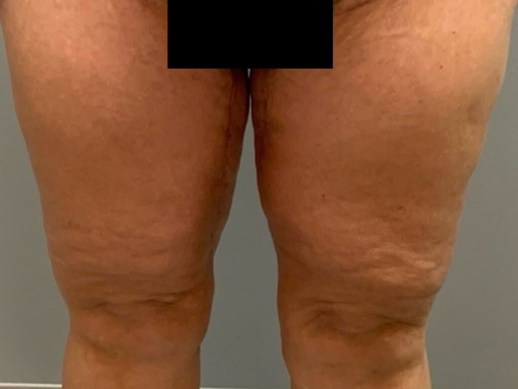 Thighplasty -Front View After