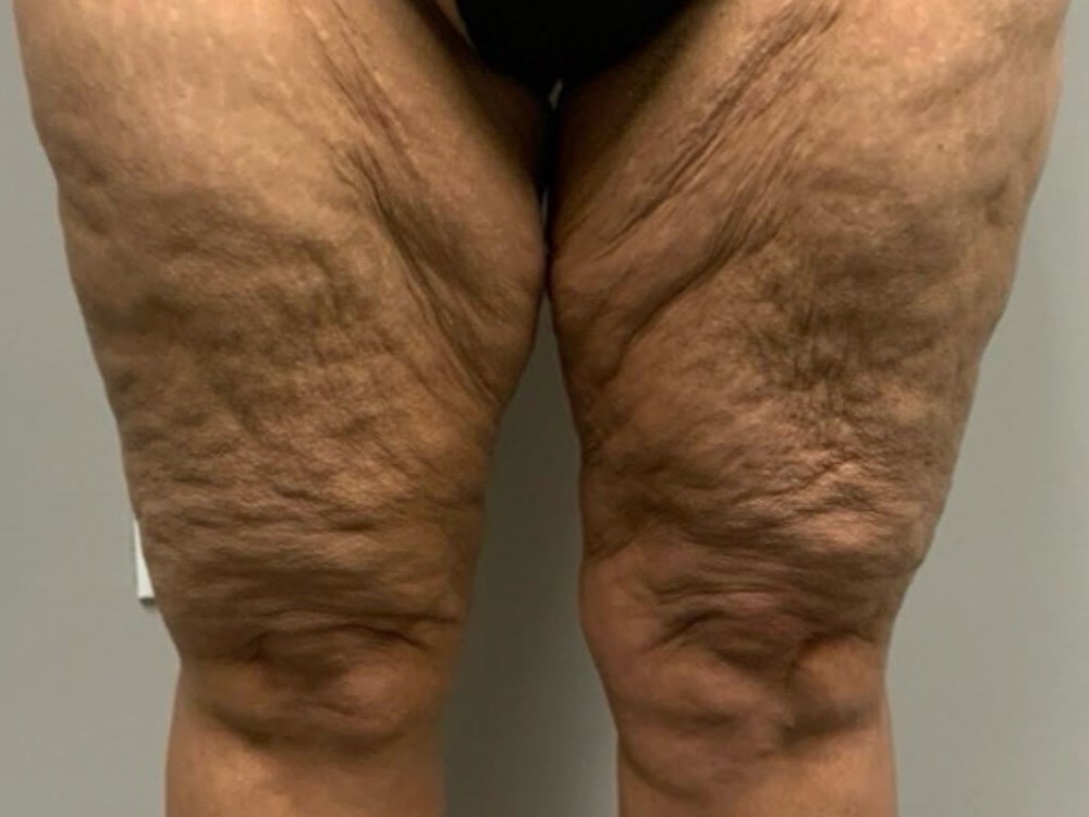 Thighplasty -Front View Before