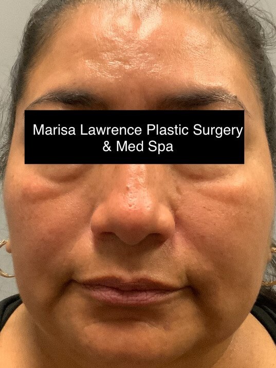 HALO Resurfacing- Front View After