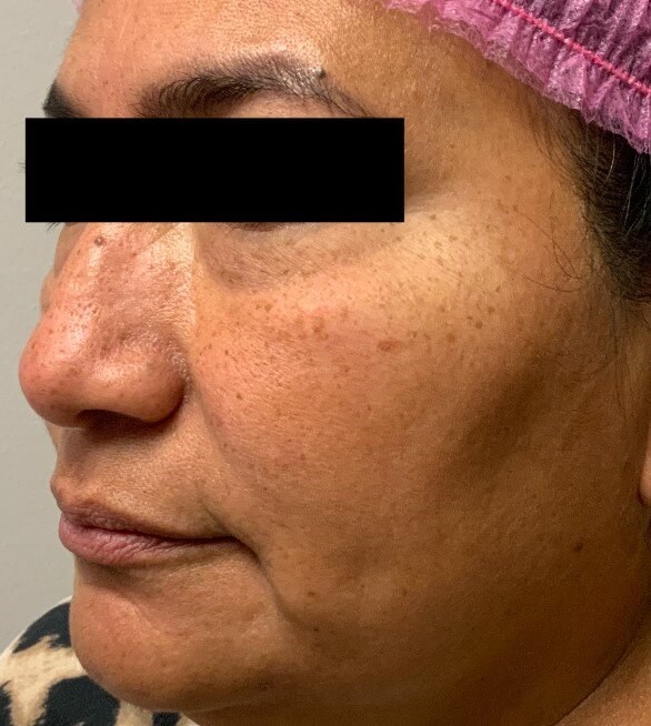 HALO Resurfacing- Front View Before