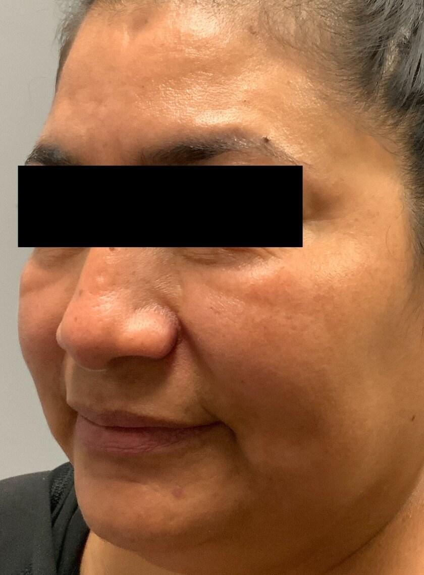 HALO Resurfacing- Front View After