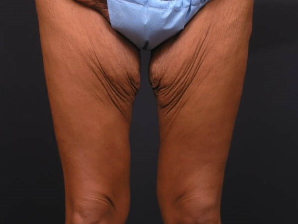 Thighplasty -Front View Before