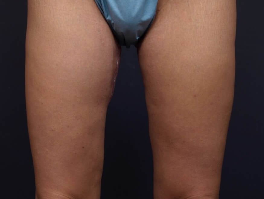 Thighplasty -Front View After