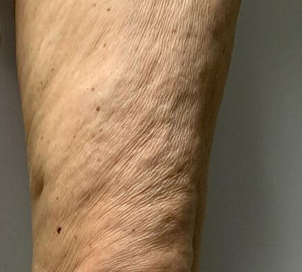 Morpheus 8- Thigh Before