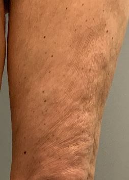 Morpheus 8- Thigh After