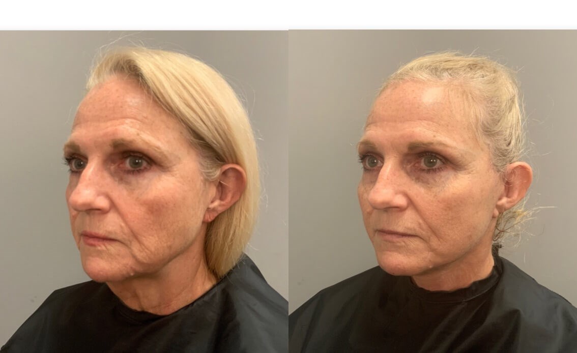 Necklift- Angled View Before