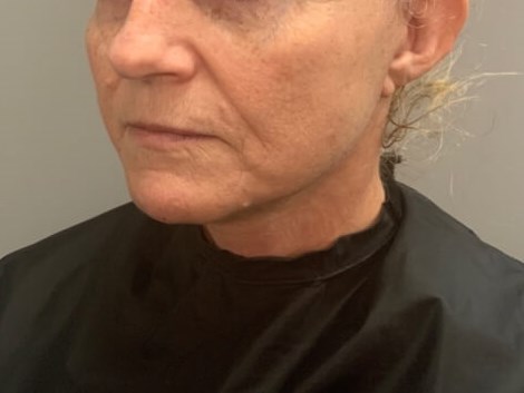 Necklift- Angled View After