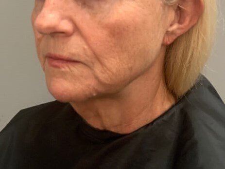 Necklift- Angled View Before