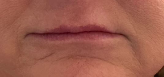 Restylane Kysse Before