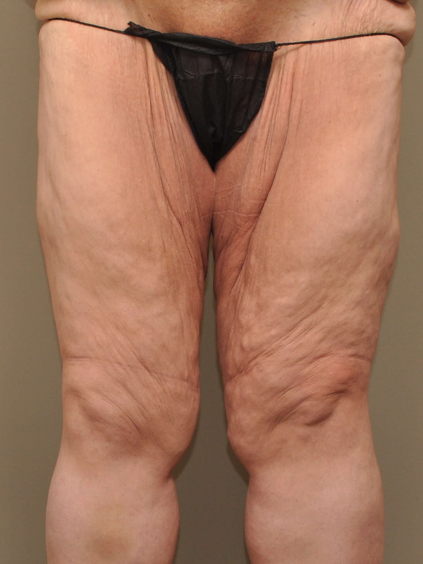 Thighplasty -Front View Before