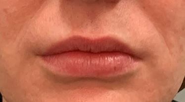 Restylane Kysse Before