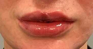 Restylane Kysse After