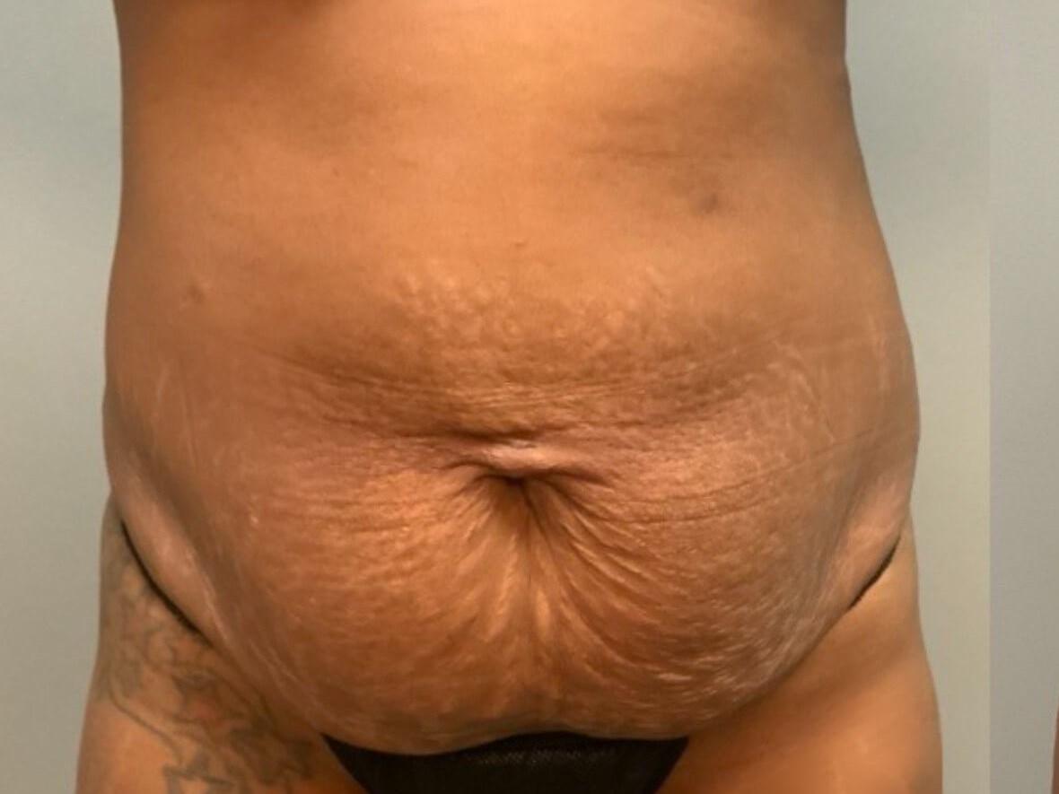 Tummy Tuck -Front View Before