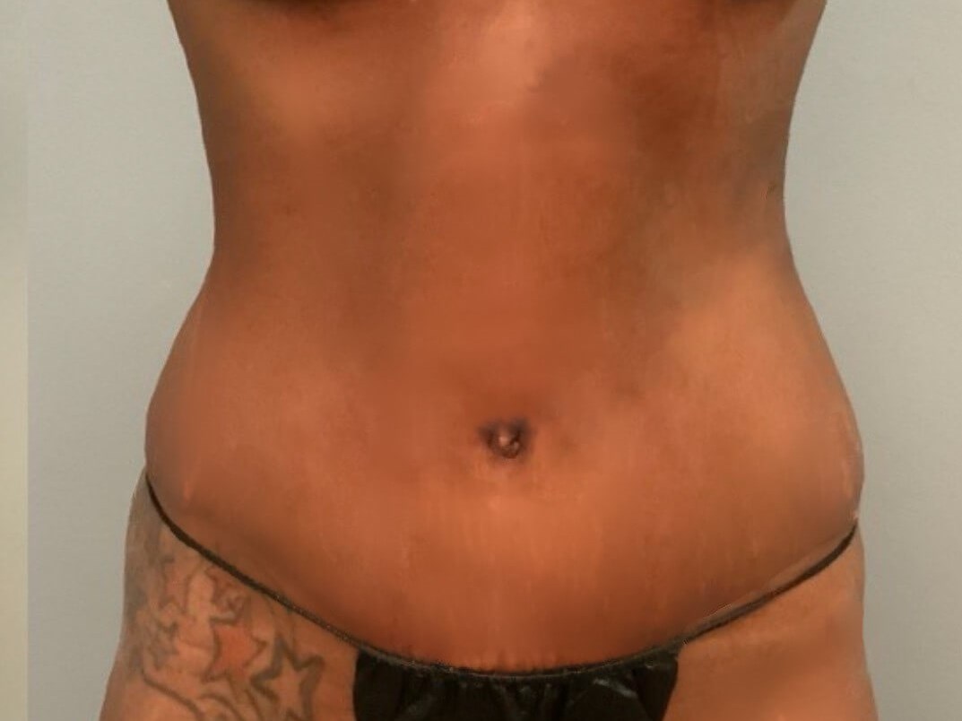 Tummy Tuck -Front View After