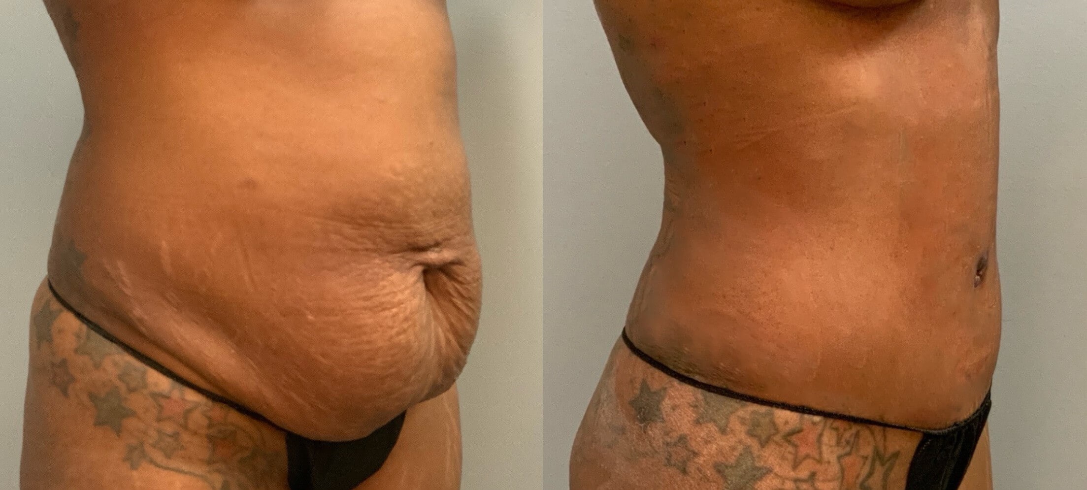 Tummy Tuck -Angled View Before