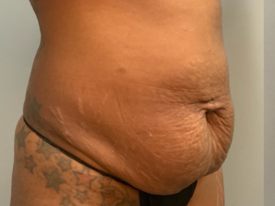 Tummy Tuck -Angled View Before