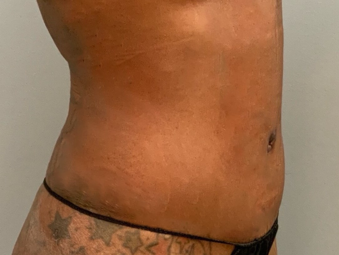 Tummy Tuck -Angled View After