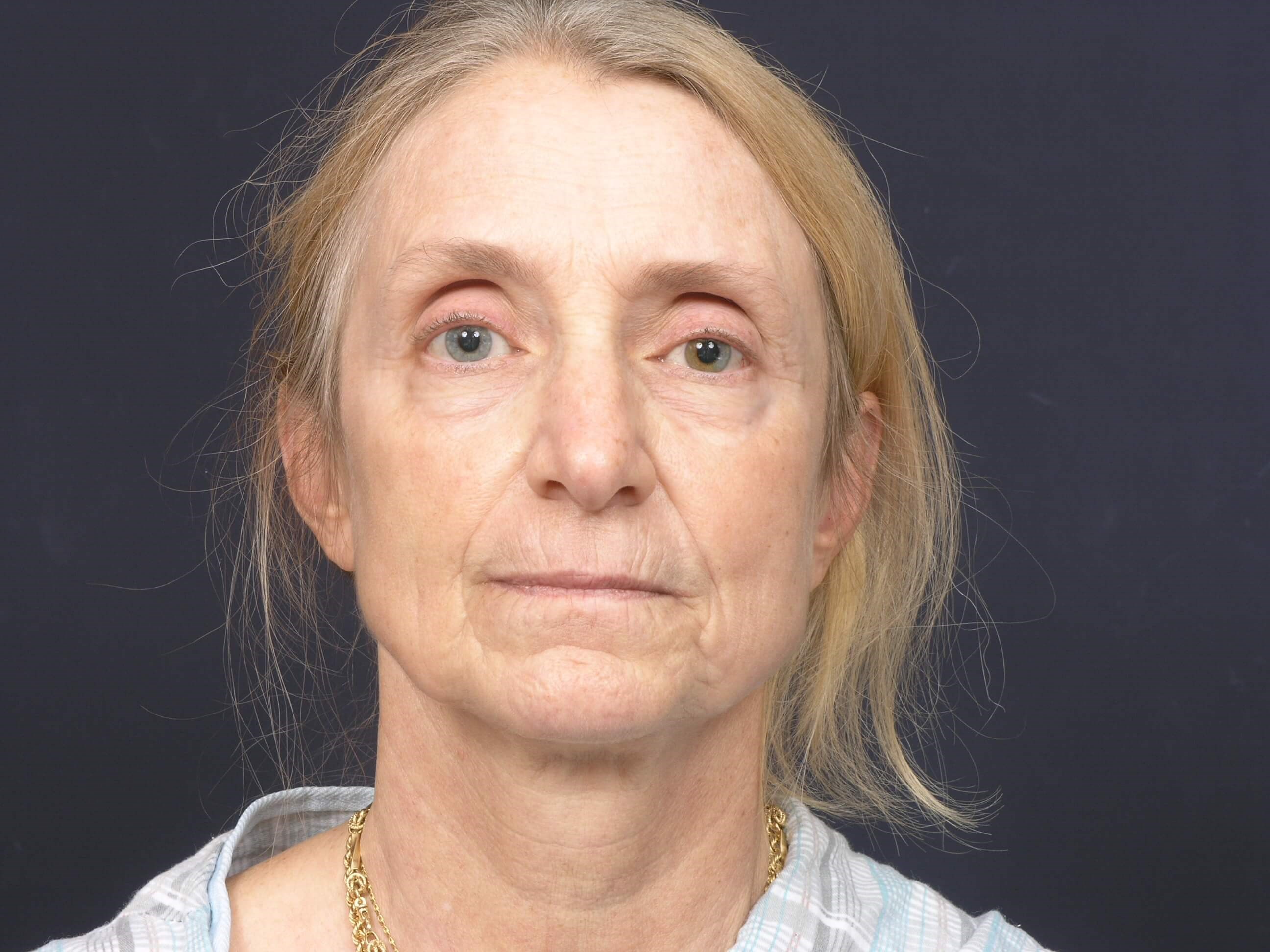 FaceLift/Necklift-Front View Before