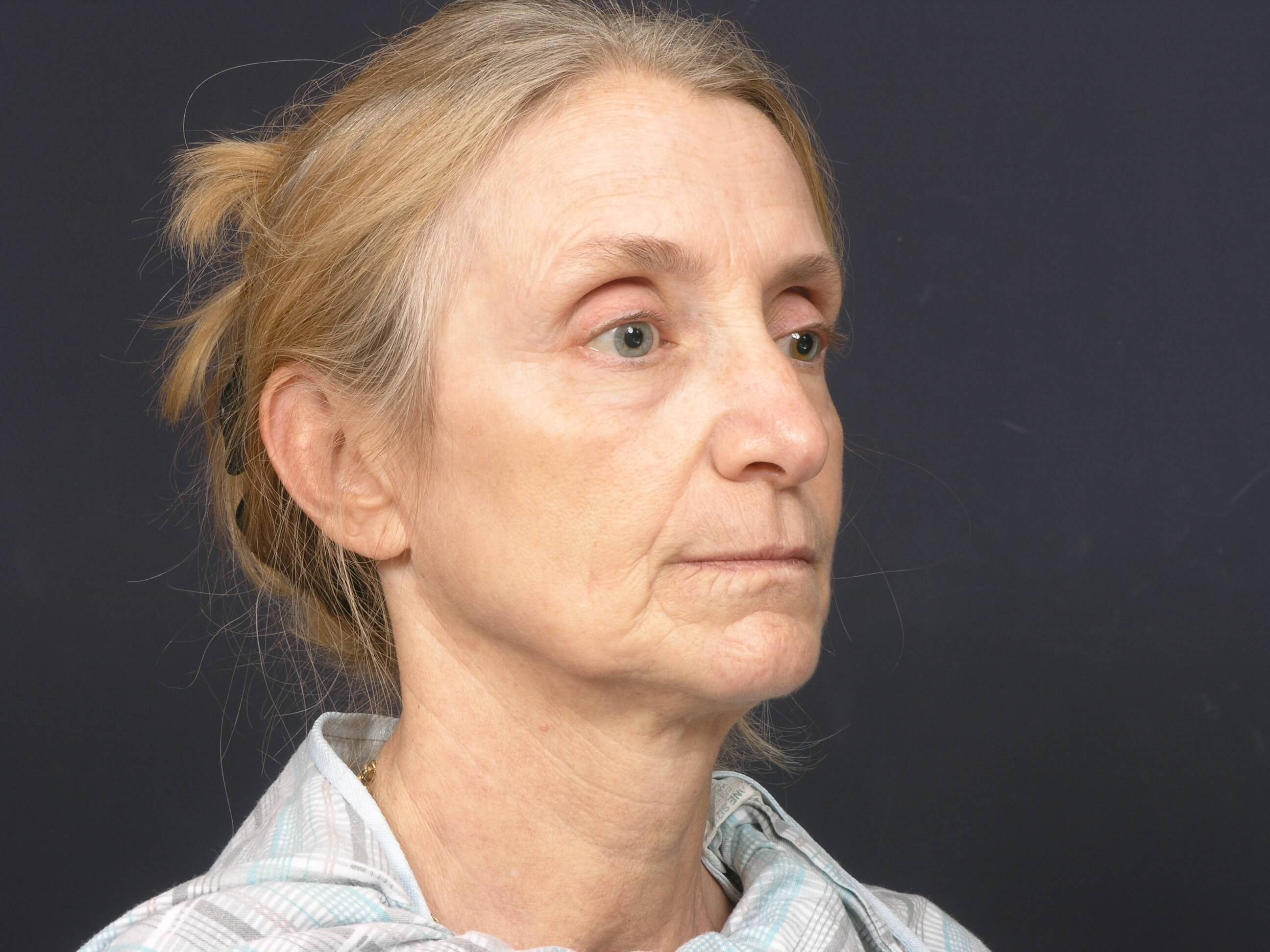 FaceLift/Necklift-Angled View Before