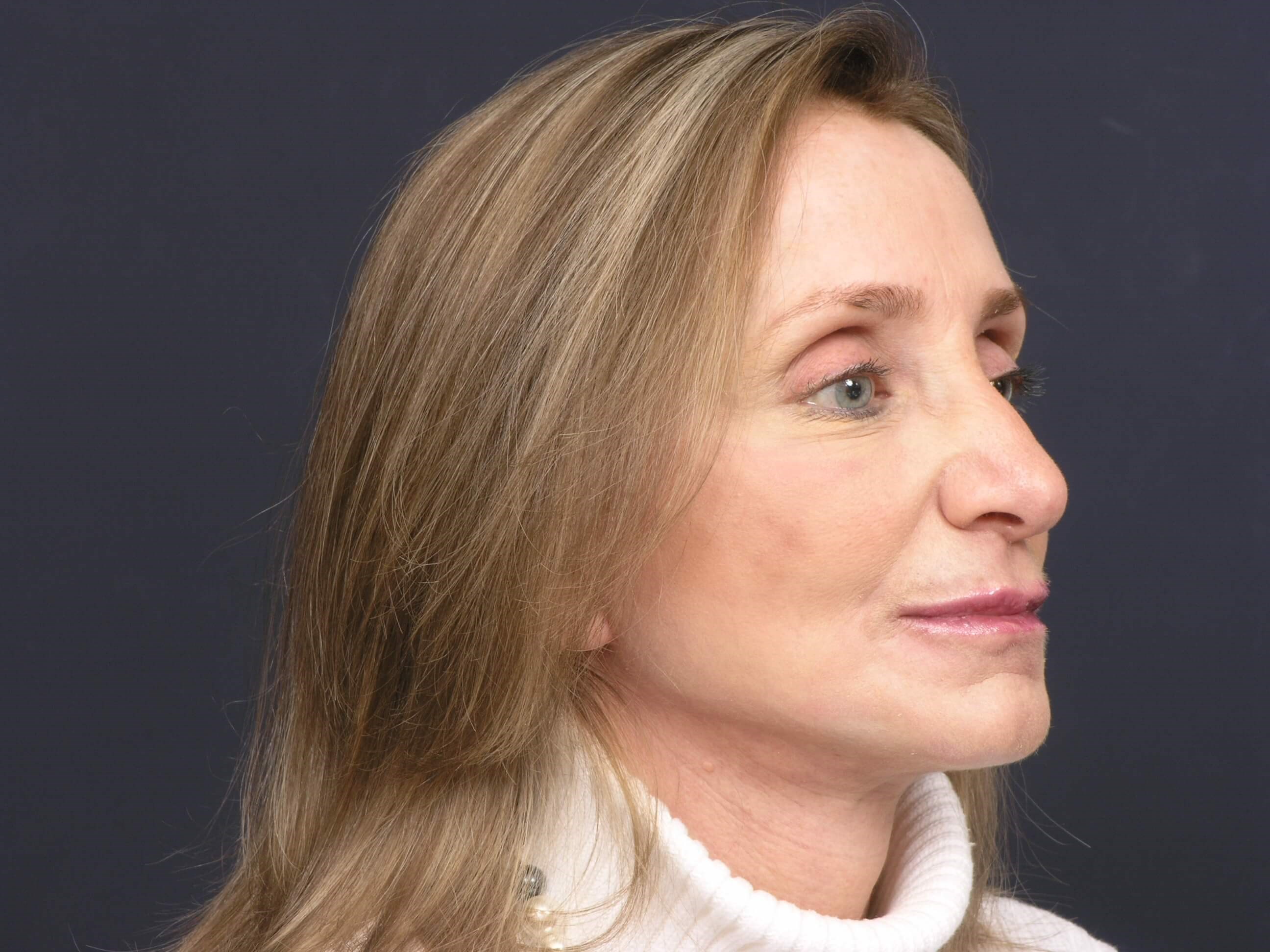 FaceLift/Necklift-Angled View After