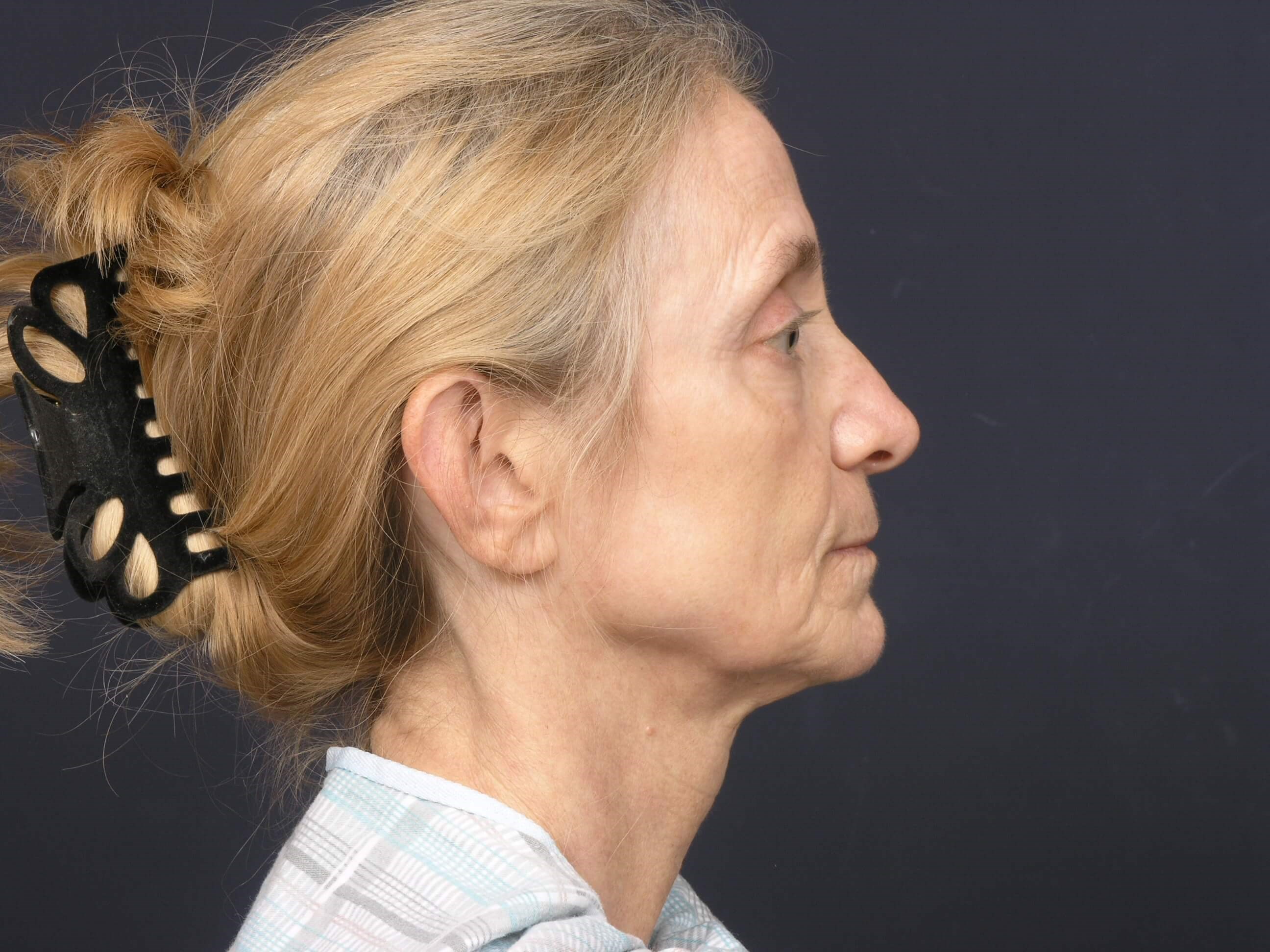 FaceLift/Necklift- SideView Before