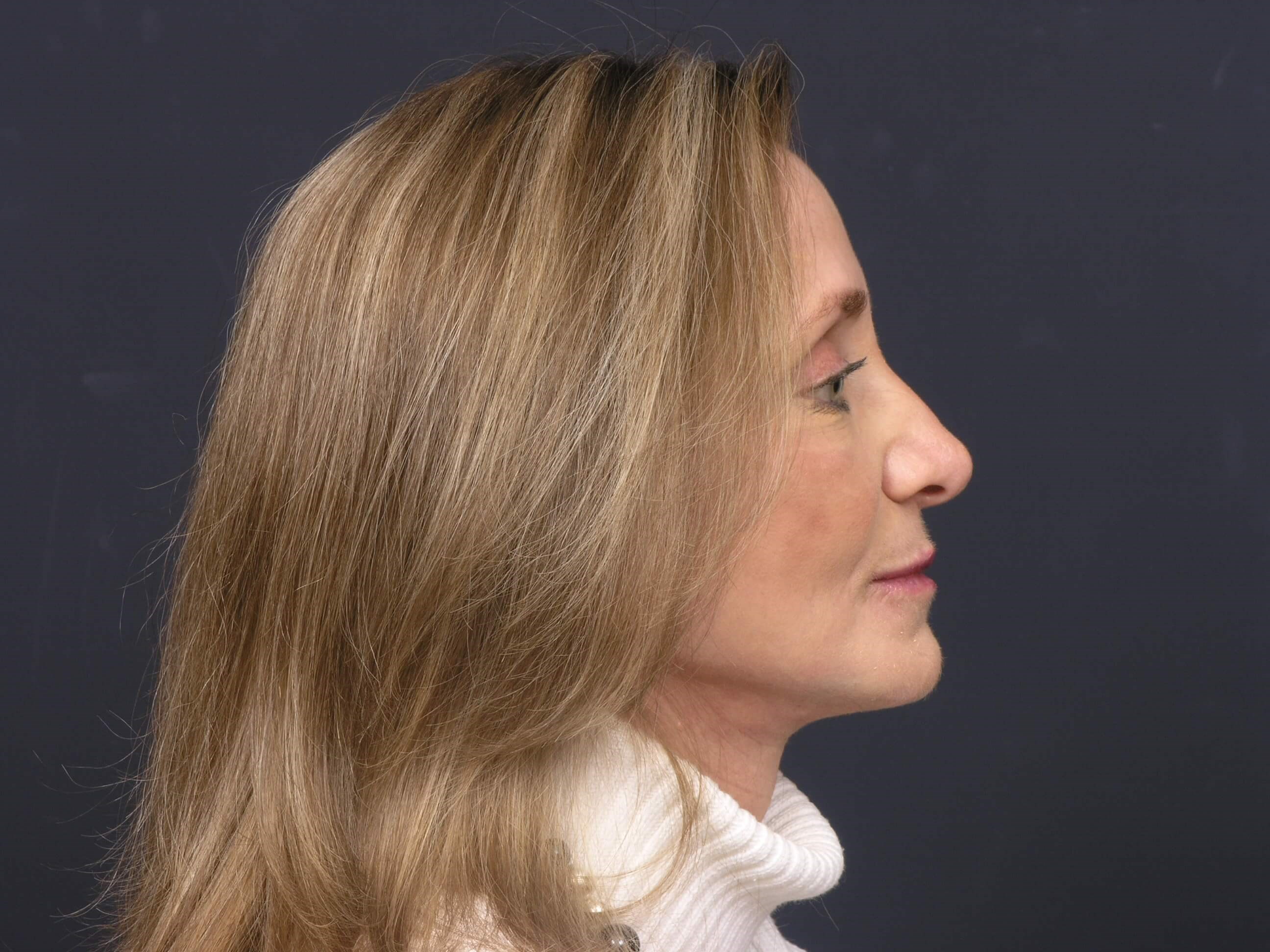 FaceLift/Necklift- SideView After