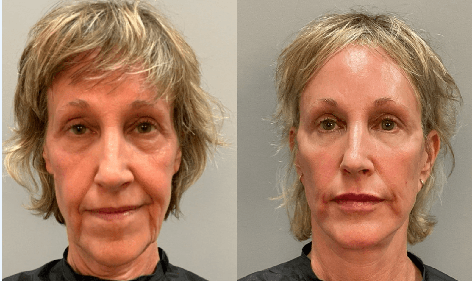 Full Face & Neck Lift Before