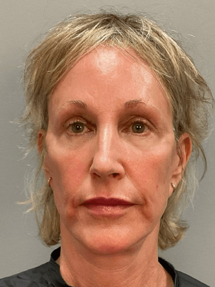 Full Face & Neck Lift After