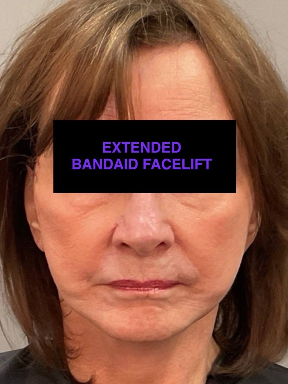 Bandaid Facelift After
