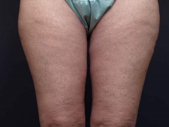 Thighplasty After