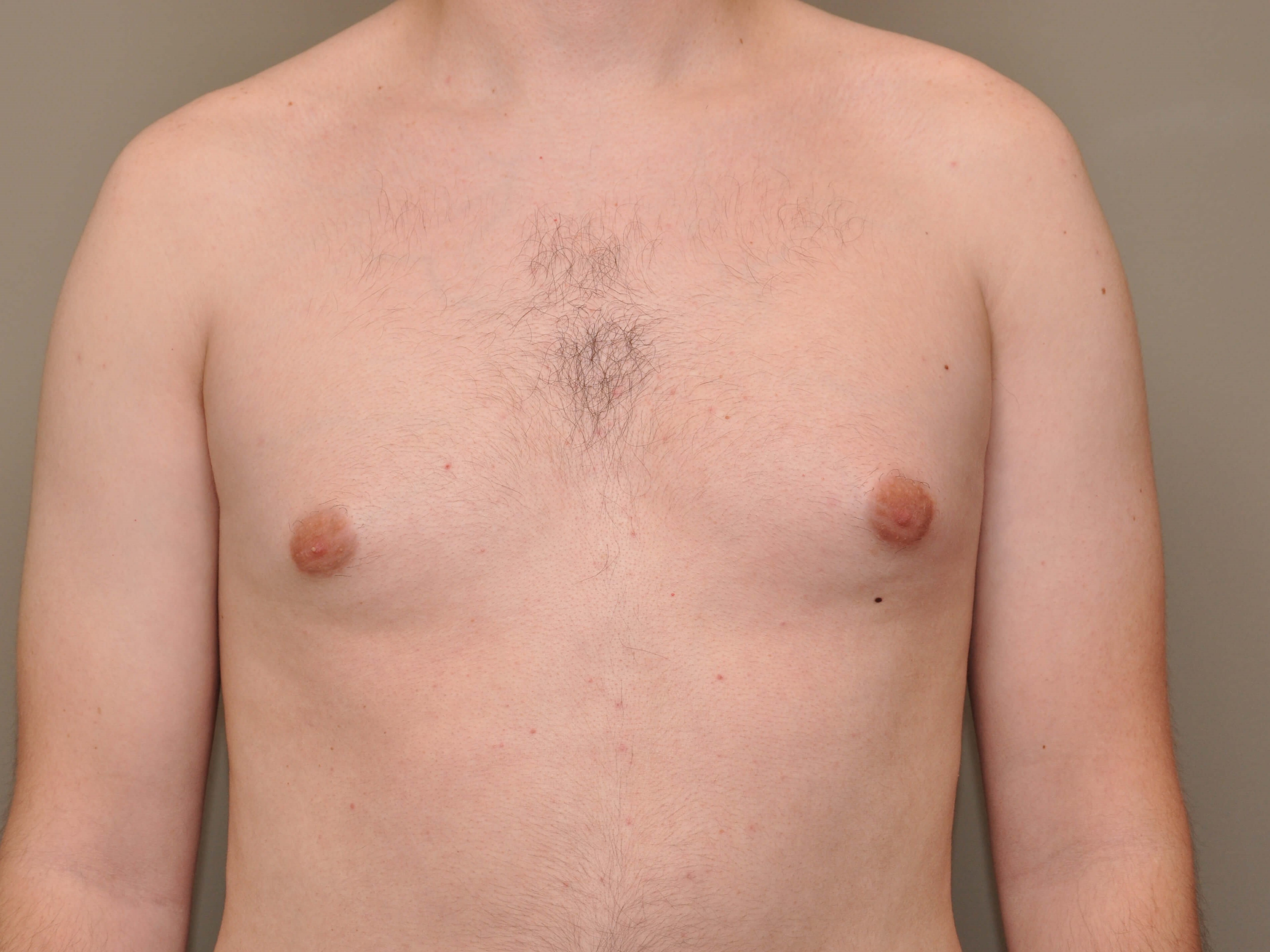Gynecomastia front view Before