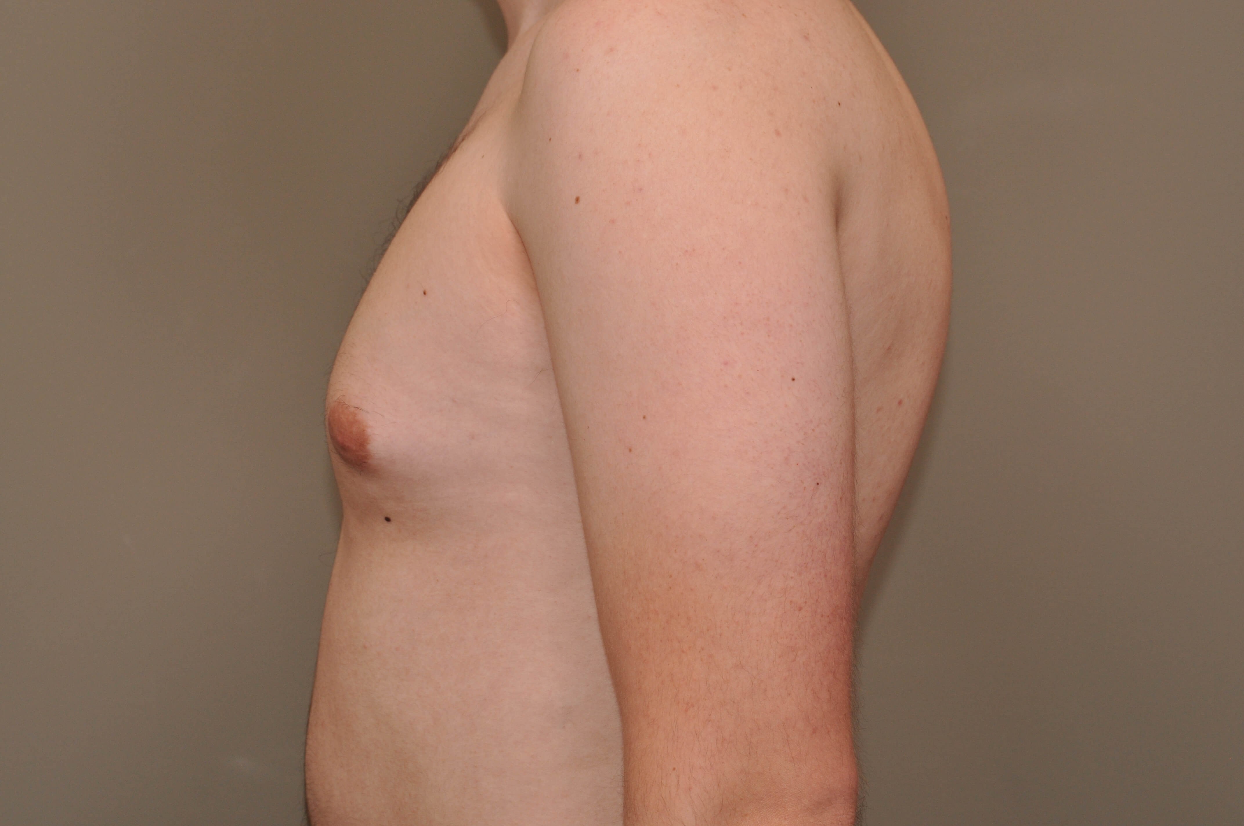 Gynecomastia side view Before