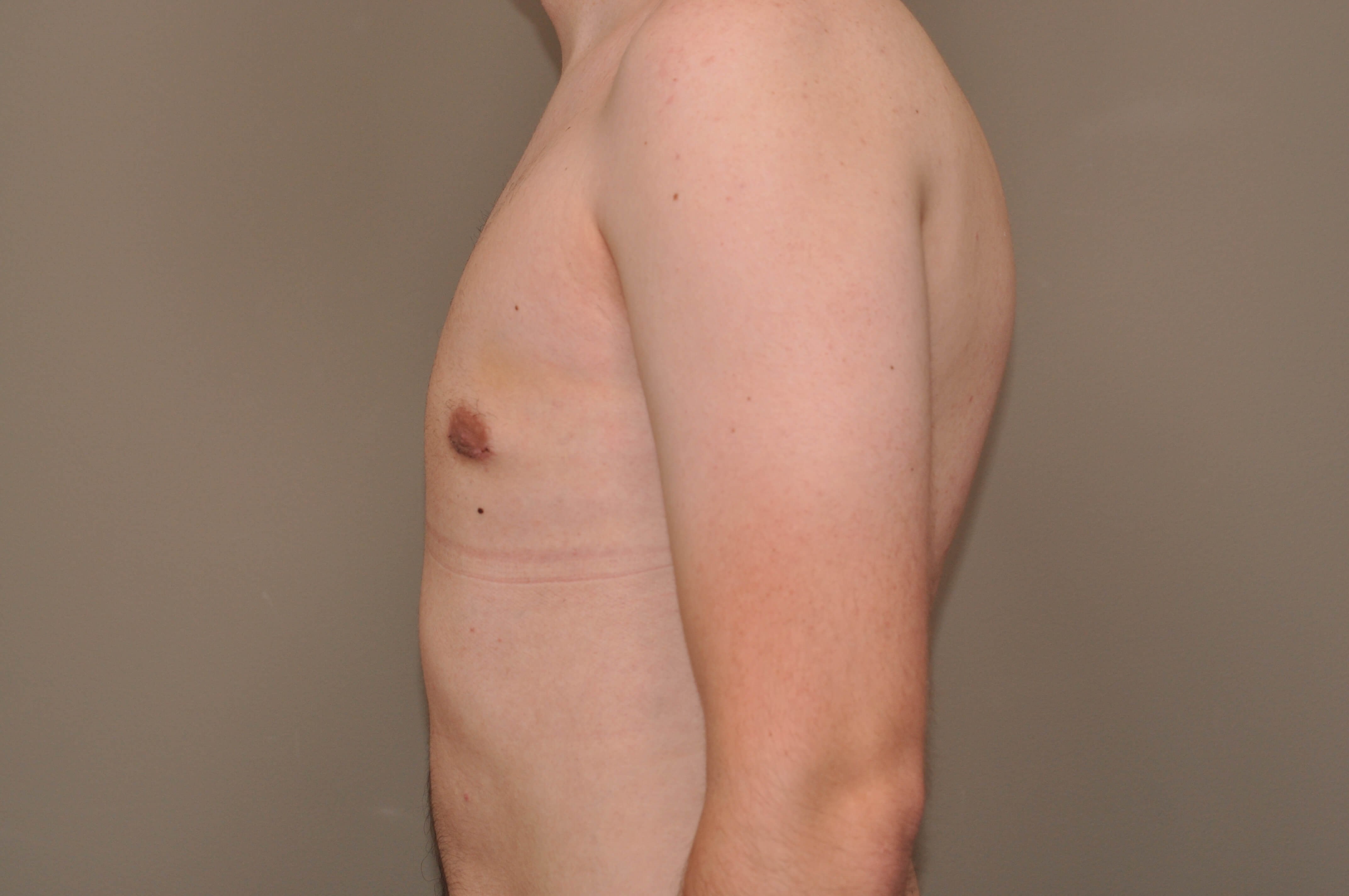 Gynecomastia side view After