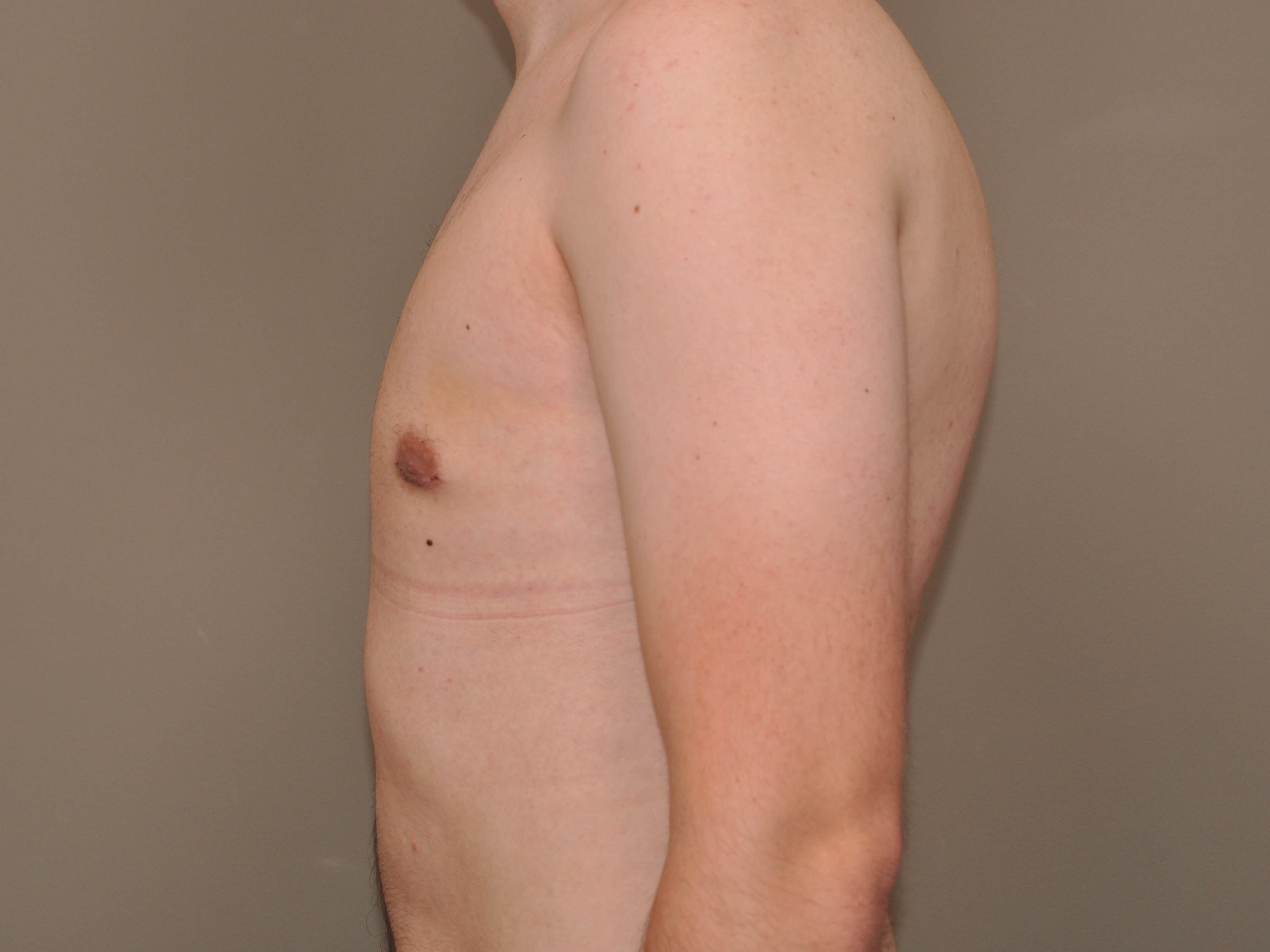 Gynecomastia side view After