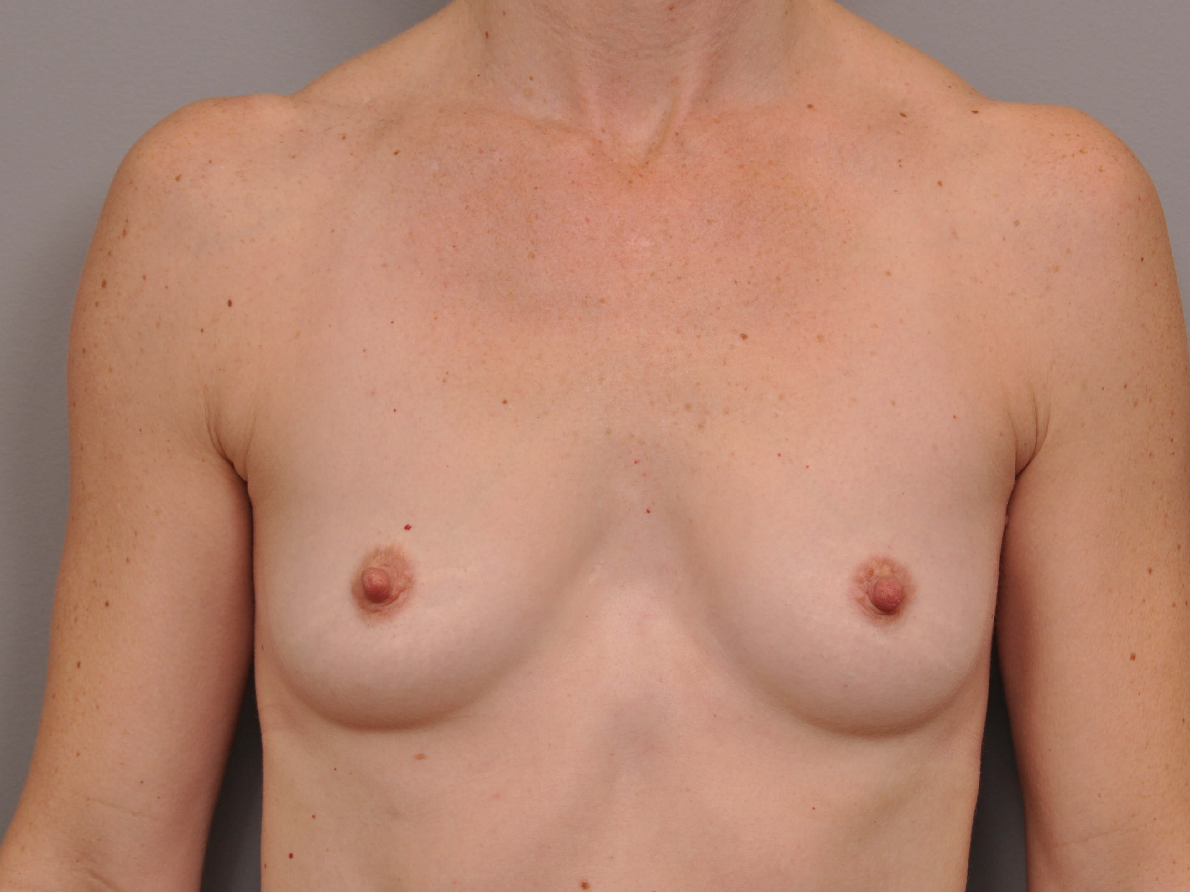 Breast Augmentation front view Before