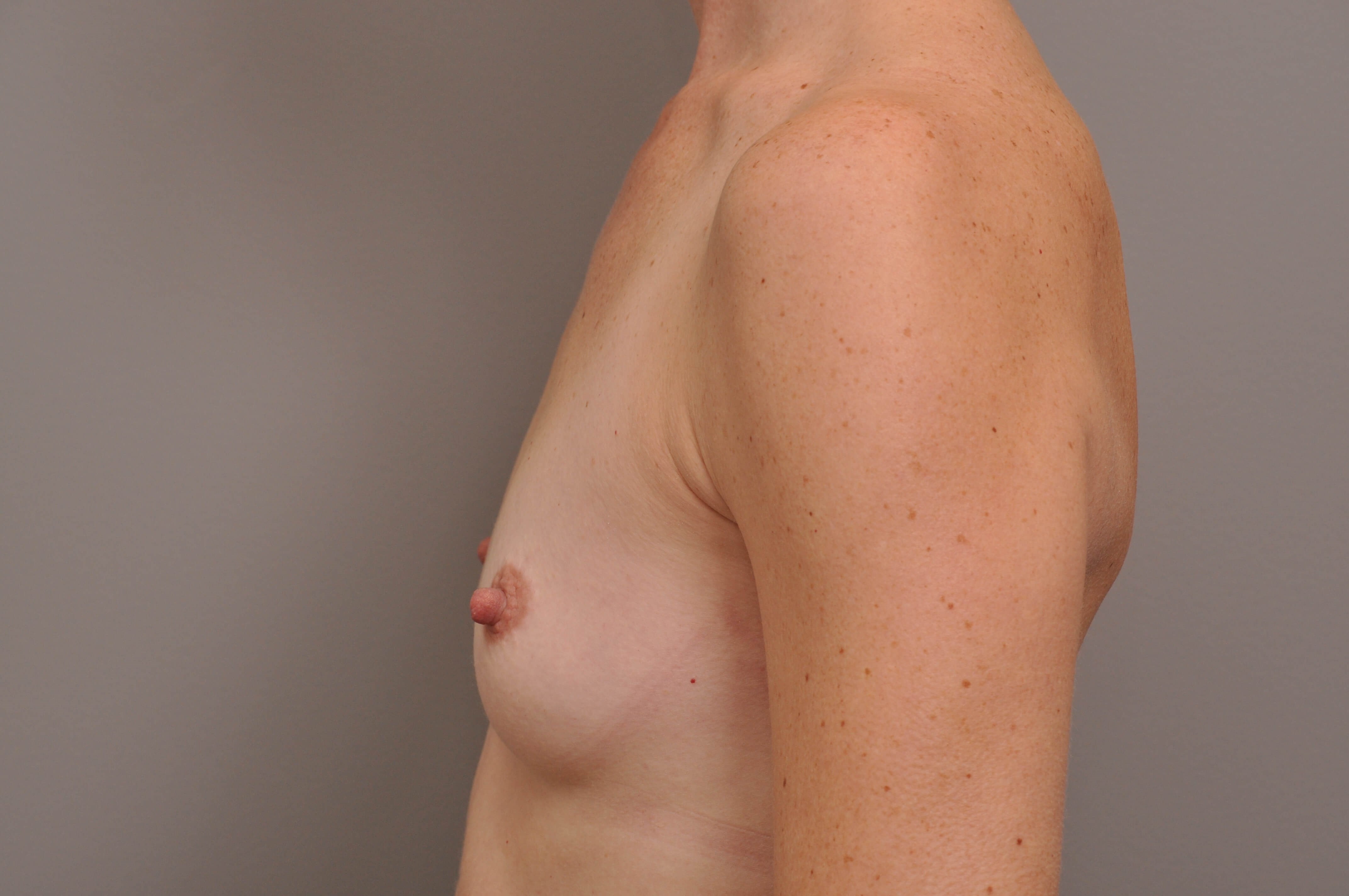 Breast Augmentation side view Before