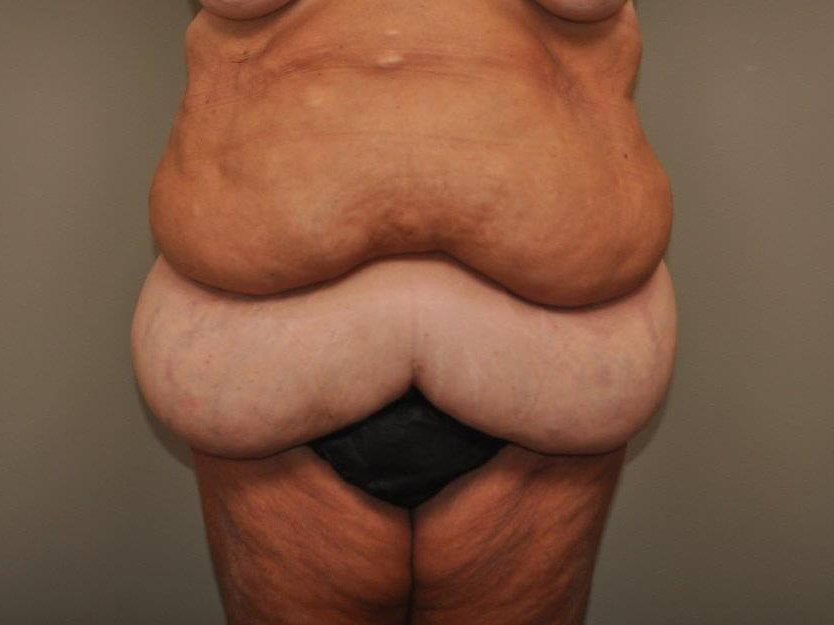 Massive Weight Loss front view Before