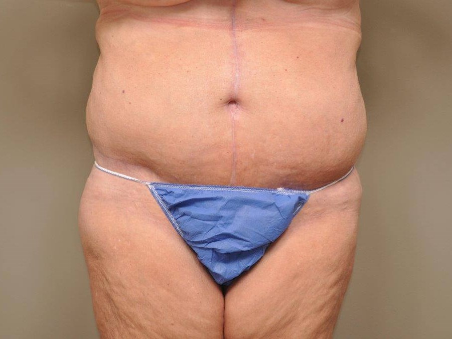 Massive Weight Loss front view After