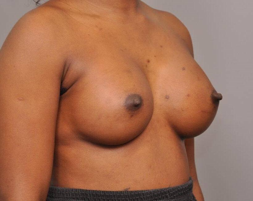 Breast Augmentation side view After